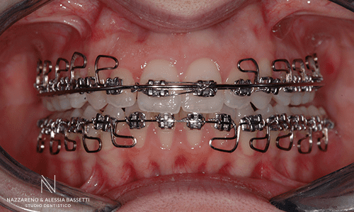 Studio Dentistico Nazzareno & Alessia Bassetti | Casi Clinici