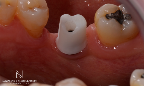 Studio Dentistico Nazzareno & Alessia Bassetti | MULTIDISCIPLINARE ORTO IMPIANTI SPLINT Impianto