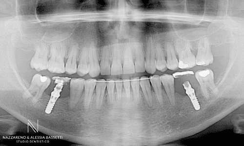 Studio Dentistico Nazzareno & Alessia Bassetti | Nazzareno Bassetti _ MULTIDISCIPLINARE ORTO IMPIANTI SPLINT Pano Fine