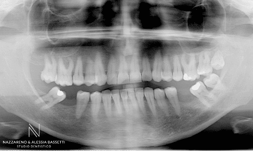 Studio Dentistico Nazzareno & Alessia Bassetti | Nazzareno Bassetti _ MULTIDISCIPLINARE ORTO IMPIANTI SPLINT Pano inizio