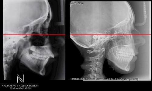 Studio Dentistico Nazzareno & Alessia Bassetti | TELERADIOGRAFIA SX INIZIO DX FINE