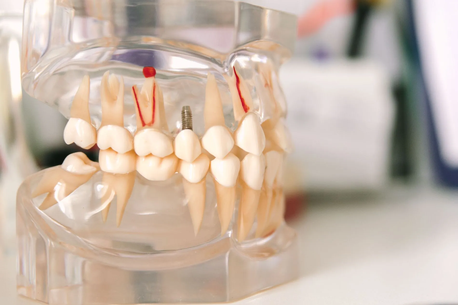devitalizzazione dente ad Ascoli Piceno
