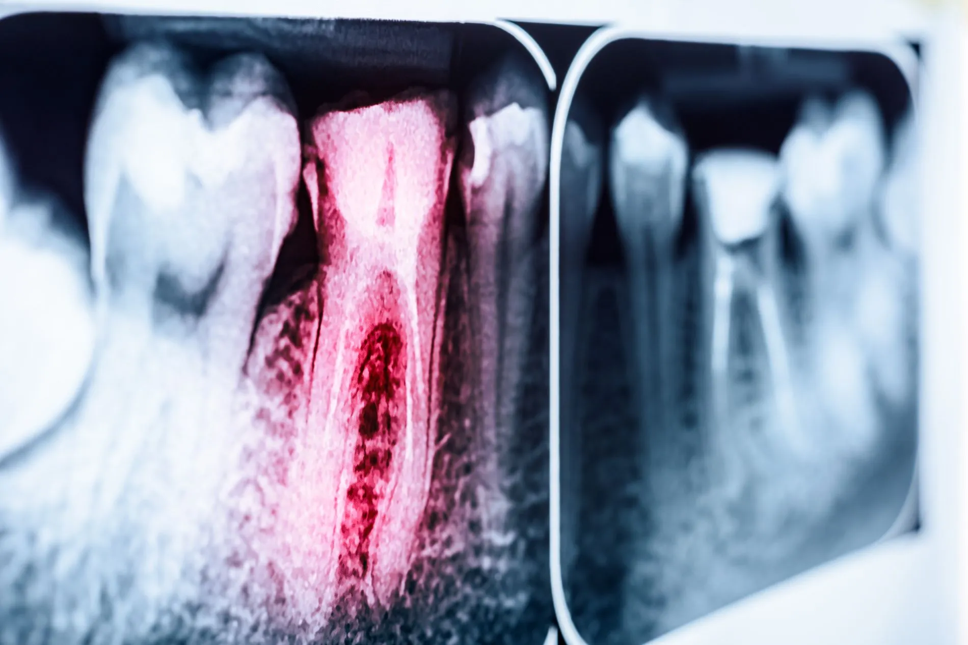 devitalizzazione dente ad Ascoli Piceno