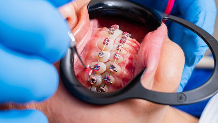 apparecchio dentale a Ascoli Piceno
